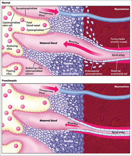 Figure 2. A schematic comparison of the structures of human placentas in normal and preeclamptic pregnancy, showing poor uterine spiral arterial remodeling in PE. Poor EVT invasion of the spiral arteries is believed to compromise the arterial remodeling. This causes reduced flow of maternal arterial blood to the placental sinusoids resulting in hypo-perfused placenta that may result in IUGR in the fetus and PE in the mother. (Adapted and modified from Wang A, Rana S, Karumanchi AS. Preeclampsia: The Role of Angiogenic Factors in Its Pathogenesis. Physiology. 2009 June; 24(3):147–158.).