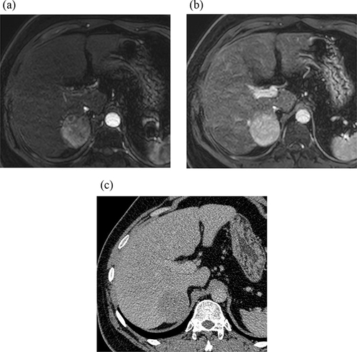 Figure 2 56-year-old man with cirrhosis and HCC. (a) APHE of Gd-EOB-DTPA MRI. Figure (b) shows no washout and no capsule in PVP of Gd-EOB-DTPA MRI. Tumor diameter > 2cm, and LR-4. Figure (c) shows washout in delayed phase of CT. Adding CT delayed phase images to Gd-EOB-DTPA MRI, the lesion was classified as LR-5.