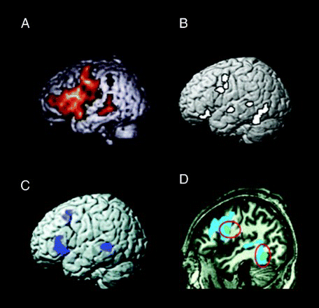 Figure 1. The “language network”: Areas of the brain frequently activated across very different language tasks. (A) Areas activated in association with silent word generation in normal controls (Prabhakaran et al., Citation2007); (B) areas of activation associated with word retrieval (naming and oral reading minus saying, “1, 2, 3”; Parker Jones et al., Citation2012); (C) areas of activation associated with syntax repetition (Segaert et al., Citation2012); and (D) areas of activation associated with reading (blue) and spelling (green; Rapp & Lipka, Citation2011). [To view this figure in colour, please see the online version of this journal.]