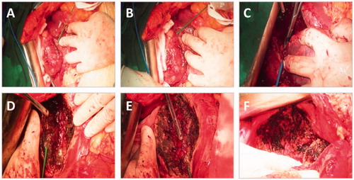 Figure 2. Pictures indicating the multiple steps of the surgery in Case #1. The microwave needle was inserted into the liver parenchyma at different sites around the tumour, and MWA was subsequently conducted (A,B). Tumor resection by the conventional clamp crushing method (C). MWA at the wound base for hemostasis (D,E). MWA of the invaded diaphragm (F).