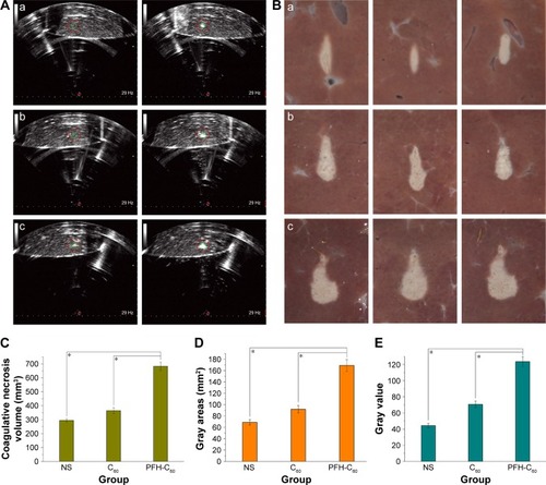 Figure 5 (A) Ex vivo evaluation of the efficiency of ultrasound imaging and HIFU therapy under the same irradiation power and duration (200 W for 9 seconds) for these three groups after intra-tissue injection of solutions and HIFU exposure of bovine livers (NS (a); C60 (b); PFH-C60 (c); left images: before irradiation; right images: after irradiation). (B) Digital photos of ablated bovine livers (NS (a); C60 (b); PFH-C60 (c)). (C–E) Corresponding necrotic volume, gray areas, and gray value (each column is the average of three data points).Note: *Significant differences between comparing PFH-C60 and C60, or the NS control at P≤0.01, respectively.Abbreviations: NS, normal saline; C60, fullerene; PFH, perfluorohexane; HIFU, high-intensity focused ultrasound.