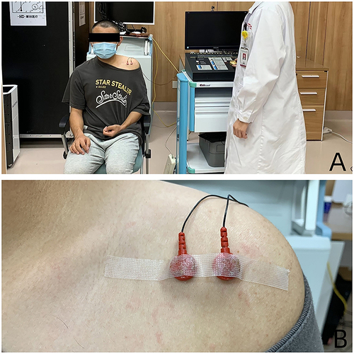 Figure 2 (A) Neurometer CPT/C sensory neuroquantitative assay. (B) The electrode is placed on the affected shoulder.