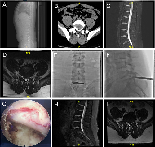 Figure 2 Case one. A 21-year-old male was admitted to our department for severe left leg radicular pain of nearly 6 months. The patient was diagnosed with L5/S1 posterior ring apophysis fracture accompanied with lumbar disc herniation (A–D). The soft herniated disc and mobile bony fragment were removed during the PEID surgery (E–G). The patient achieved immediate pain relief and was discharged from hospital within 4 days. The functional improvement was well at 6 months after PEID (H and I).