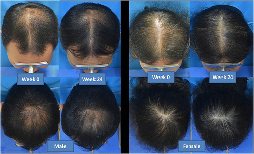 Figure 1 Efficacy of Low-level laser therapy for the treatment of androgenetic alopecia. Reproduced from Suchonwanit P, Chalermroj N, Khunkhet S. Low-level laser therapy for the treatment of androgenetic alopecia in Thai men and women: a 24-week, randomized, double-blind, sham device-controlled trial. Lasers Med Sci. 2019;34(6):1107–1114. Creative Commons Attribution 4.0 International License. (https://creativecommons.org/licenses/by/4.0/).Citation75