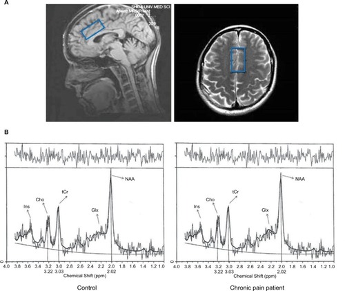 Figure 1 (A) The blue rectangle shows the location of a single voxel in the anterior cingulate cortex. (B) Representative proton magnetic resonance spectroscopy spectrum from the anterior cingulate cortex fit with LCModel.