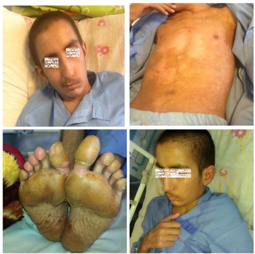 Figure 2 The physical examination of patient was normal 10 days after admission and his lymphadenopathies resolved.