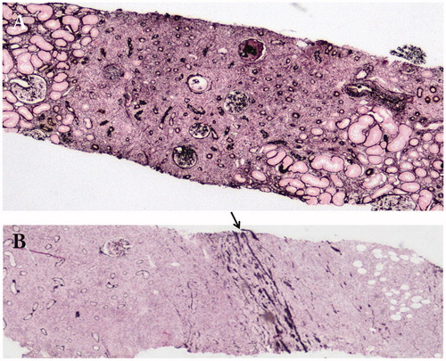 Figure 3. The specific distribution of renal parenchymal lesions. (A) The margin between affected and unaffected areas is very clearly demarcated (periodic acid-methenamine-silver staining ×40); (B) Lymphoplasmacytic cells infiltrate into and beyond the renal capsule (arrow: renal capsule) (periodic acid-methenamine-silver staining ×40).