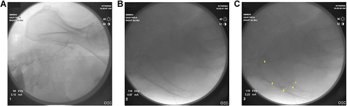 Figure 1 (A). Anteroposterior view prior to sacroiliac joint intraarticular injection. (B). Lateral view prior to sacroiliac joint intraarticular injection. (C). Lateral view post sacroiliac joint intraarticular injection.