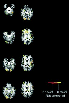 Figure 11. Activation associated with reading for Participant 5. Functional magnetic resonance imaging (fMRI) data are adjusted for multiple corrections and are presented with threshold of p < .05. [To view this figure in colour, please see the online version of this journal.]