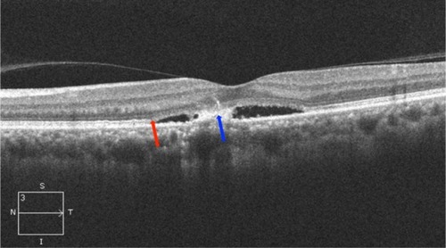 Figure 12 Chronic central serous chorioretinopathy showing disruption of ISel band and ELM (red arrow), and serous detachment and fibrin collection (blue arrow).