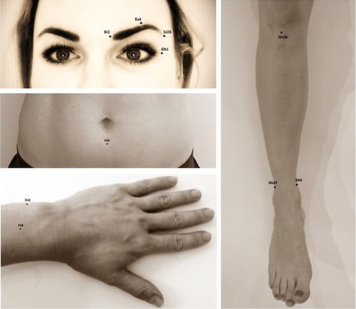 Figure 2 Illustration of needling points in the eye-specific acupuncture scheme and the eye-unspecific acupuncture scheme in primary open-angle glaucoma patients.