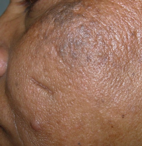 Figure 2 Multiple comedones on the upper cheek and a solitary inflammatory papule.