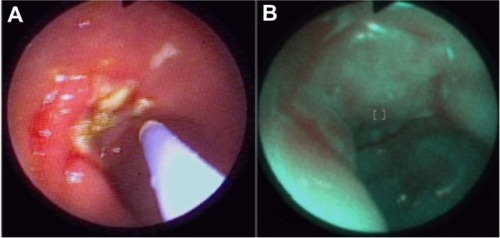 Figure 15 Monitoring the effect of ulceration treatment with argon laser coagulation (A) with autofluorescence imaging after treatment (B).