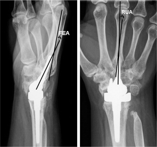 Figure 2. Left panel: The flexion-extension angle (FEA) is the angle between the line through the middle of the metacarpal stem and the middle of the third metacarpal on the lateral radiograph. Right panel: Radial-ulnar angle (RUA) is the angle between the middle of the metacarpal stem and the middle of the third metacarpal on the anterior-posterior radiograph.