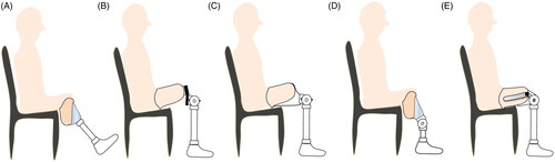Figure 5. A shows a transtibial amputee sitting with a bent knee prosthesis without an extra joint; B shows a transfemoral amputee sitting with a bent hip prosthesis with a flexion contracture plate; C shows compensation material to offset the socket; D and E show transtibial and transfemoral amputees with an extra joint underneath the socket to increase the seating cosmetic.