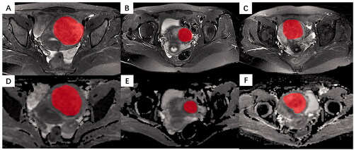 Figure 1. The cases for delineating ROI. The preoperative MR images for uterine leiomyomas received NPV ratios ≤50%, 50–80% and ≤80% after HIFU ablation on (a–c) T2W images and (d–f) ADC maps.