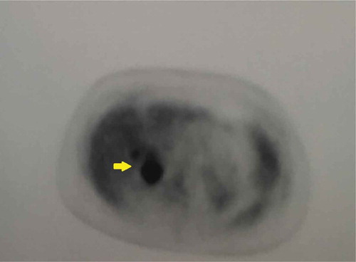 Figure 2. PET scan showing intense FDG (fluorodeoxyglucose) localization within the enlarged right adrenal gland (yellow arrow).