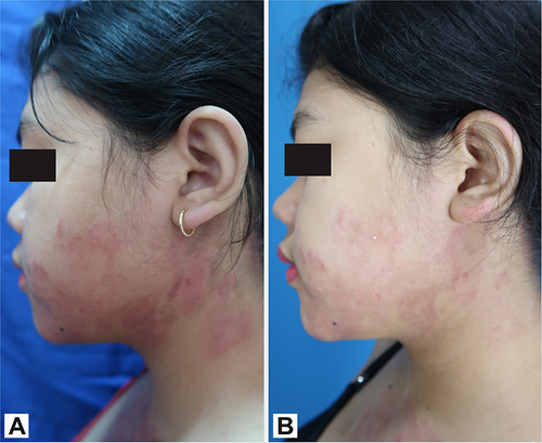 Figure 3 Comparison between skin manifestation on the left cheek and neck before (A) and after four sessions of PDL treatment (B).