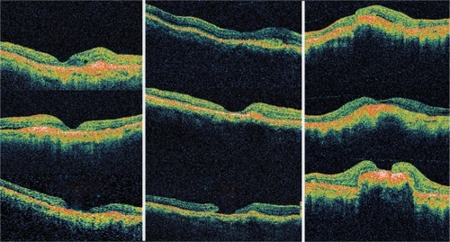 Figure 2 Sequential comparison of optical coherence tomography scans over time for the three study eyes. Column 1 denotes Case 1: At presentation (left, top), two months after initial treatment (left, middle), and at last follow-up (left, bottom). Column 2 denotes Case 2: At presentation (central, top), four weeks after initial treatment (central, middle), and at last follow-up (central, bottom). Column 3 denotes Case 3: At presentation (right, top), four weeks after initial treatment (right, middle), and at last follow-up (right, bottom). Cases 1 and 3 reveal progressive retinal thinning at the macula, while Case 2 reveals retinal thinning with evolution of full- thickness macular hole.