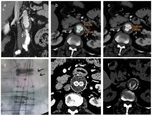 Figure 3. (a). A 55 mm juxtarenal Abdominal Aortic aneurysm in a 70 year-old female patient ineligible to sustain open repair or complex endovascular solution. (b). The outer-to-outer wall of the infrarenal neck wall reaches a maximum diameter of 37 mm at 7 mm infrarenally. (c). Yet, the lumen diameter differs significantly from the outer diameter, estimated 19–25 mm. (d). An Ovation Alto achieved successful sealing in the distended neck, deployed actually within the aneurysm. The arrows depict the transition of the aneurysm extending proximally to the infrarenal level. (e). Absence of endoleaks confirmed 1-month postoperatively in computed tomography with intravenous contrast. (f). The landing of the radiopaque polymer-filled ring within the lumen against the burden of the thrombus surface in the non-contrast computed tomography (image courtesy of Dr. Georgakarakos).