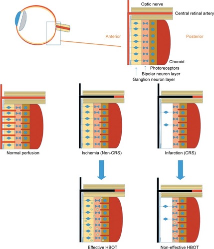 Figure 3 The ischemic cascade in the retina. At normal perfusion, the retina has a double circulation from both choroidal and retinal systems. When the central retinal artery is occluded, the inner retina suffers ischemia. Depending on the residual blood flow from the choroidal system, with time the ischemia can result in anoxia of the inner retina. The anoxia can be clinically seen as a CRS since when the inner retina is infarcted there are opacification changes. HBOT can effectively increase oxygen diffusion from the patent choroidal system to the inner retina and reverse the ischemic damage as long as irreversible infarction has not yet developed.