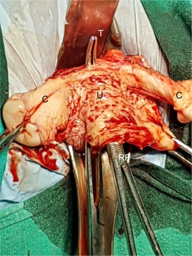 Figure 9 T of the RFs that was penetrated adjacent to uterus (U) through a bladder-free area of uterovesical adhesions to enter anterior cul-de-sac.