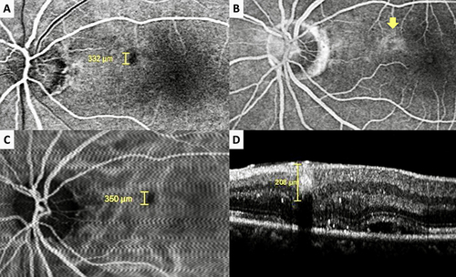 Figure 1 Case 4, Left eye of a 49-year-old male with Behcet’s uveitis. Arteriovenous phase of fluorescein angiogram (FA) (A) demonstrating the hypofluorescent lesion due to an occluded intraretinal macroaneurysm (IMA) appearing as an isolated aneurysmal dilation. Late venous phase of FA (B) demonstrating the leakage from the IMA (arrow). Indocyanine green angiographic section (C) reveals a well-defined circular lesion without any leakage. Horizontal spectral domain optical coherence tomographic section passing through the IMA (D) disclosing a hyperreflective round lesion with a hyperreflective border in association with the intraretinal hyperreflective dots and subretinal fluid.
