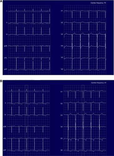 Figure 2 Second cardiac event.