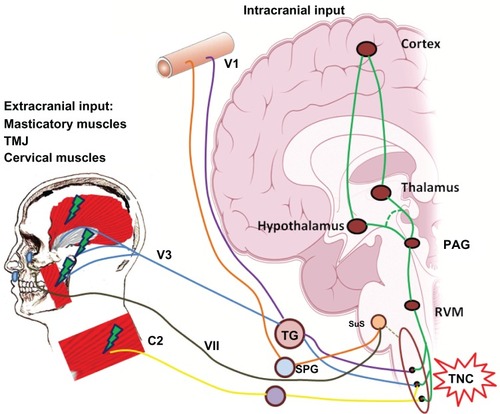 Figure 4 Relationship between temporomandibular disorders and headache.