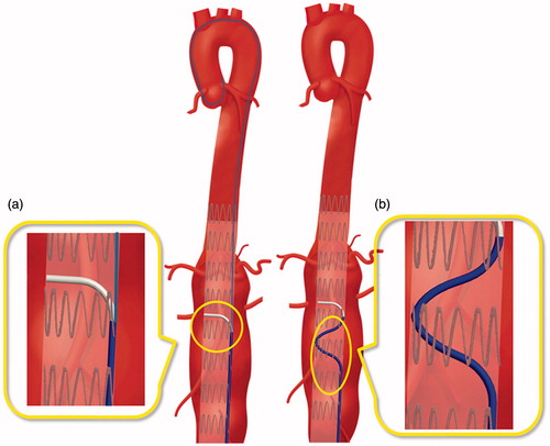 Figure 3. Proposed design solutions for catheter stabilization: (a) ‘Piton-like’ catheter employing a stiff guidewire as a ‘stabilizer’; and (b) a design based on a preformed shape of the catheter body to increase the contact area between the catheter and the graft.