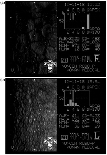 Figure 3.  Scan images of the central cornea of both eyes were captured by microscopy 3 months after onset. Six-sided cells were lost and endothelial cell density was 392–612/mm2 in the affected eye (a) and 2433/mm2 in the contralateral eye (b) (75–84% decrease). Central corneal thickness of the affected eye was 610 µm and higher than that of the contralateral eye.