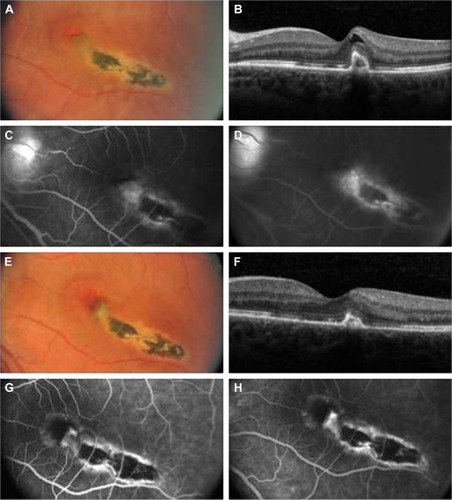 Figure 1 (A) Baseline fundus photographs (OS) show a macular scar with fibrosis, subretinal fluid, and hemorrhage. (B) Baseline optical coherence tomographic (OCT) scan shows increased retinal thickening and a highly reflective subretinal complex. (C and D) Baseline early- and late-phase fluorescein angiographic images show leakage from choroidal neovascularization. (E) Posttreatment fundus photographs taken at 4 months show a macular scar and no evidence of subretinal fluid or hemorrhage. (F) Posttreatment OCT scan taken at 4 months shows decreased retinal thickness and a persistent highly reflective subretinal complex. (G and H) Posttreatment early- and late-phase fluorescein angiographic images taken at 4 months show no evidence of leakage.