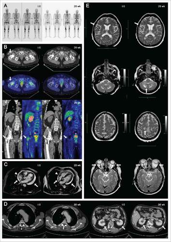 Figure 2. Skeletal involvement of patient 2 at time point 0 and at 28th week assessed by 99mTc-MDP bone scans (A) and by FDG-PET scan (B): upon treatment, humeral lesions were no longer detectable as tracer uptake or radiologic abnormalities at CT-PET, while femoral lesions improved markedly (arrows). Marked reduction of pericardial effusion (arrows) and right atrium infiltration (from 12 to 7 mm in diameter, arrowheads) in patient 1 before and after 28 week of treatment, as assessed by cardiac MRI (C). Improvement in thoracic aorta involvement and bilateral perinephric fat infiltration (arrows) in patient 1 at time point 0 and 96th week assessed by contrast enhanced CT-scan of the abdomen (D). Retro-orbital, cerebral and cerebellar disease progression in patient 3, as assessed by brain-MRI at baseline (t = 0; E, left) and after 28 weeks of tocilizumab therapy (t = 28; E, right).