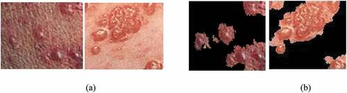 Figure 4. Segmentation of vesicular rash: (a) Original image, (b) Segmented vesicular rash using the segmentation tool.