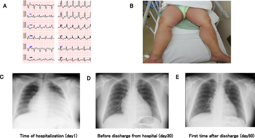 Figure 1 Imaging data on admission and clinical course based on chest X-ray. (A) electrocardiography, (B) patient’s edema, (C–E) clinical course based on chest X-ray.