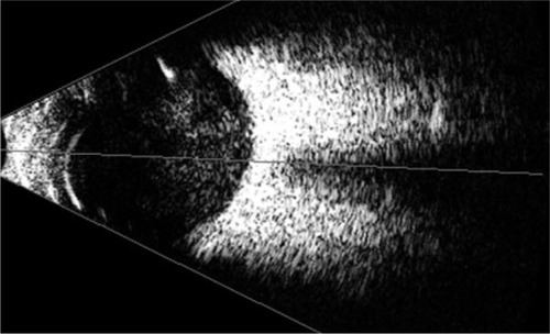 Figure 2 B-scan ultrasound of the right eye shows a significant amount of vitreous debris.