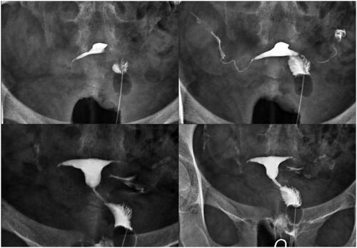 Figure 3. Traction of the uterus with single-tooth tenaculum technique, as in 15% of HSG exams.