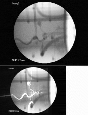 Figure 2. X-ray image of vascular phantom (top) with MIP generated from MR volume using registration matrix (bottom). (Abstract 383)