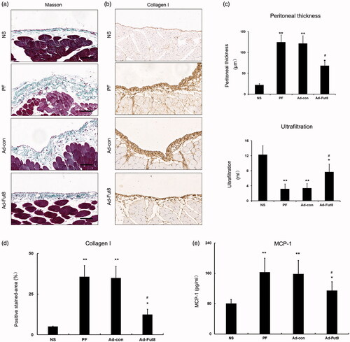 Figure 4. Fut8shRNA alleviated peritoneal structural and functional alteration and collagen I accumulation in rats with peritoneal fibrosis: (a) representative photographs of Masson’s staining (bar = 100 μm); (b) representative photographs of collagen I accumulation in peritoneal membrane (immunohischemistry, bar = 100 μm); (c) analysis of peritoneal thickness and ultrafiltration volume; (d) analysis of positive stained-area (%) of collagen I accumulation in peritoneal membrane; for quantitative assessment, an average of 5 independent measurements of positive stained - area (%) was calculated for each section using Image-Pro Plus 6.0 software; (e) analysis of MCP-1 in peritoneal effluent. Results are expressed as mean ± SEM of eight rats per group. *p < 0.05, **p < 0.01 vs. NS group. #p < 0.05 each group (except for NS group) vs. both PF and Ad-con group.