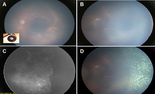 Figure 2 (A) Left eye of a premature infant 11 months after injection of intravitreal bevacizumab who was lost to follow-up. The right eye had a closed funnel retinal detachment. (B) Pre-retinal fibrous tufts were noted in zone 2 with significant persistent peripheral avascular retina. (C) The result was confirmed based on angiography (RetCam 3, Natus, CA, USA). (D) The eye underwent laser photoablation of the avascular retina.