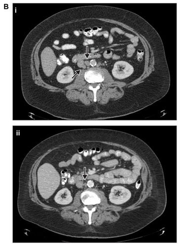Figure 2B CT scans from patient 2 taken in (i) September 2008 and (ii) July 2012.Note: Arrows in both panels indicate sites of metastases.Abbreviation: CT, computed tomography.