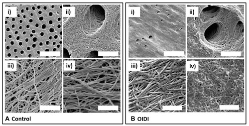 Figure 3 (A) SEM images of control dentin: i) pre-demineralisation (scale bar 20µm): regular dentinal tubule arrangement, tubules are open and uniform in appearance; ii) post demineralisation (scale bar 2µm): higher magnification image of tubules, collagen scaffold is visible inside the tubules and in the surrounding space; iii) and iv) post demineralisation (scale bar 800nm): higher magnification images showing regular D-banding periodicity of collagen fibrils. (B) SEM images of OIDI dentin: i) pre-demineralisation (scale bar 20µm): tubules varying in size and partially blocked or occluded; ii) post demineralisation (scale bar 2µm): “nesting” of several tubules can be seen within a larger tubule, collagen can be seen in the tubule (scale bar 2 µm), iii) post demineralisation (scale bar 800nm): higher magnification image showing regular D-banding periodicity of collagen fibril; iv) post demineralisation (scale bar 800nm): higher magnification image showing collagen fibril coalescence.