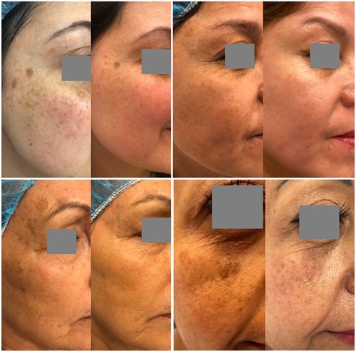 Figure 1 Four patients before and after treatment, 4 weeks after the last peeling. Patients consented to use of images.