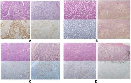 Figure 2 Representative sections at 100x magnification showing one case of a primary tumour with a matched lymph node (Panel A primary tumour, 1.0; lymph node, 0.9. Panel B primary tumour, 0; lymph node, 0. Panel C primary tumour, 0; lymph node, 0.4. Panel D primary tumour, 0.15; lymph node, 0).