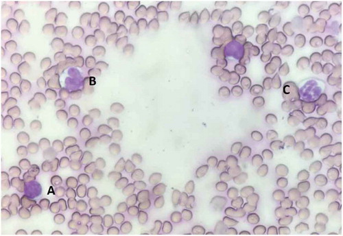 Figure 2. White blood cell differentiation is performed on blood smear with Wright-Geimsa staining. (a) Lymphocyte is characterized by dark purple circular nucleus; (b) Monocyte is characterized by a purple kidney-shaped nucleus with lysosomes in cytoplasm; (c) Neutrophil is characterized by purple multi-lobular nucleus.