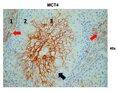 Figure 8. MCT4 epithelial immunostaining in HNSCC tumor tissue. Three different tumor regions or metabolic compartments are as indicated: (1) is the tumor stroma; (2) represents the proliferating cancer cell compartment and (3) is the non-proliferating cancer cell compartment. Note that MCT4 staining is primarily localized to the tumor stroma (red arrows) and the non-proliferating epithelial cancer cell compartment (black arrow). Note also that the non-proliferating MCT4+ cancer cells appear enlarged or hypertrophic, which is consistent with a senescent phenotype. Original magnification: 40×, as indicated.