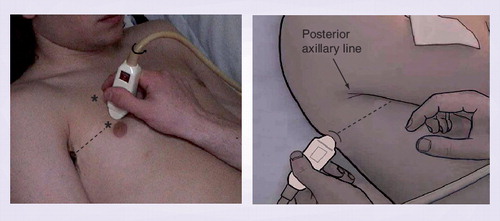 Figure 2. Practical analysis of the lung.The left image first demonstrates one standardized point of analysis: the lower part of the anterior thorax in a supine patient (lower asterisk). Other points include one point at the upper part (upper asterisk), and one semiposterior point above the diaphragm, continuing the lower anterior point. Second, we can see the 5-MHz microconvex probe that makes critical ultrasound easy. This one in particular can analyze from 1 to 17 cm, i.e., the pleural line as well as the deep lung consolidations, and the whole body (venous network, heart, abdomen and optic nerve). This probe is smart: no time is lost changing it (meaning neither disinfecting it or purchasing it). The 8-cm probe length allows posterior analysis of critically ill patients who are in the supine position.Reprinted from Citation[5] with permission from Springer Science+Business Media.