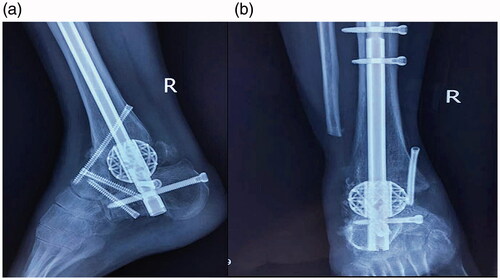 Figure 5. No signs of dislocation, nonunion, pathologic fractures or pathological bone resorption were shown in right ankle by a/p (a) and lateral (b) radiographic evaluation at 3 months follow-up.