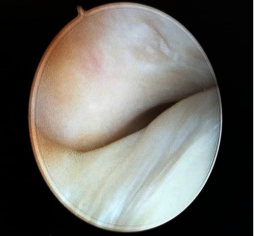 Figure 2 TMJ arthroscopy, superior space.