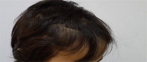Figure 3. Dermatological examination revealed broken hairs (with no vellus), providing proof that it has been shaved.
